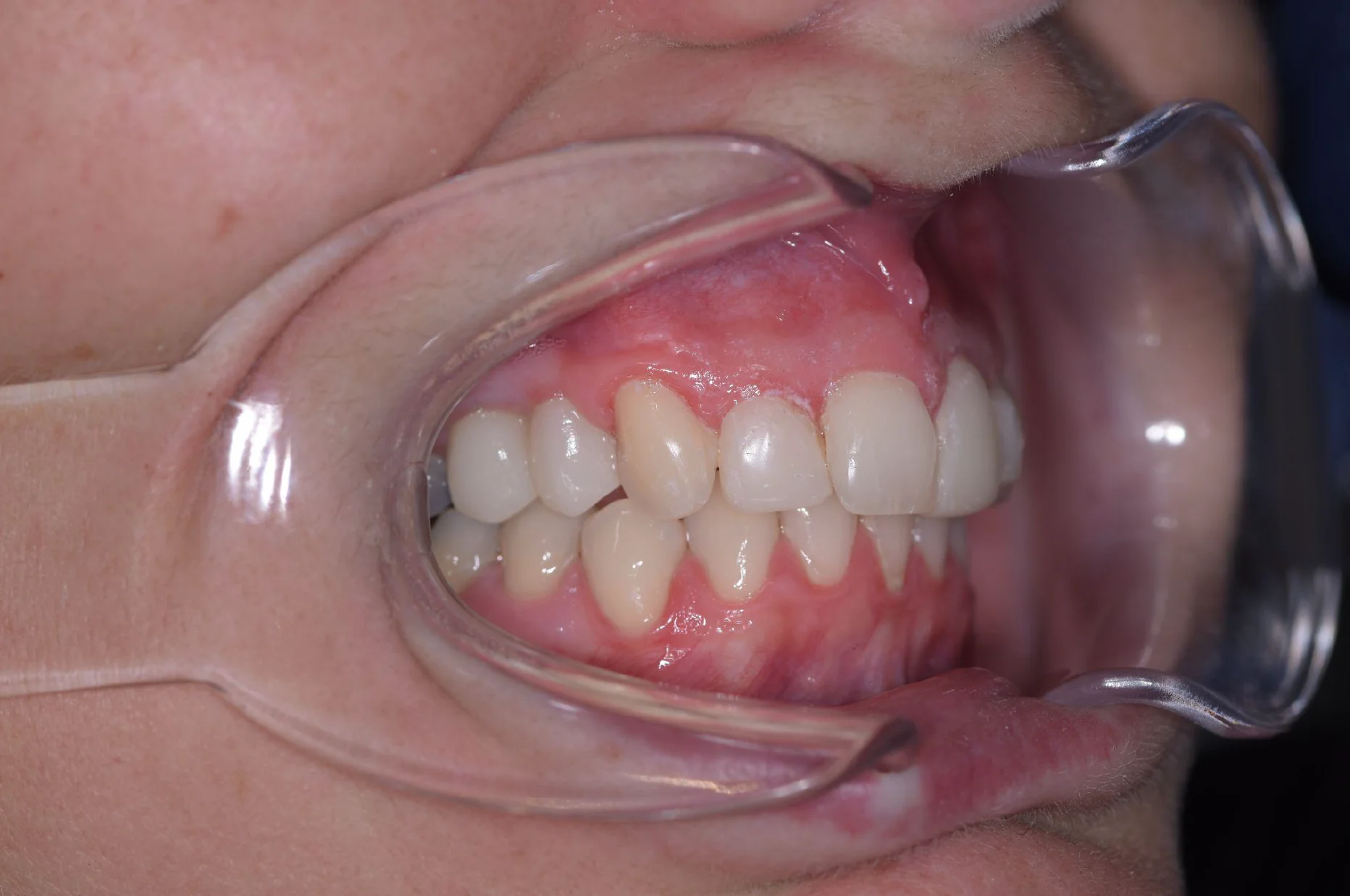 Dental Implants After