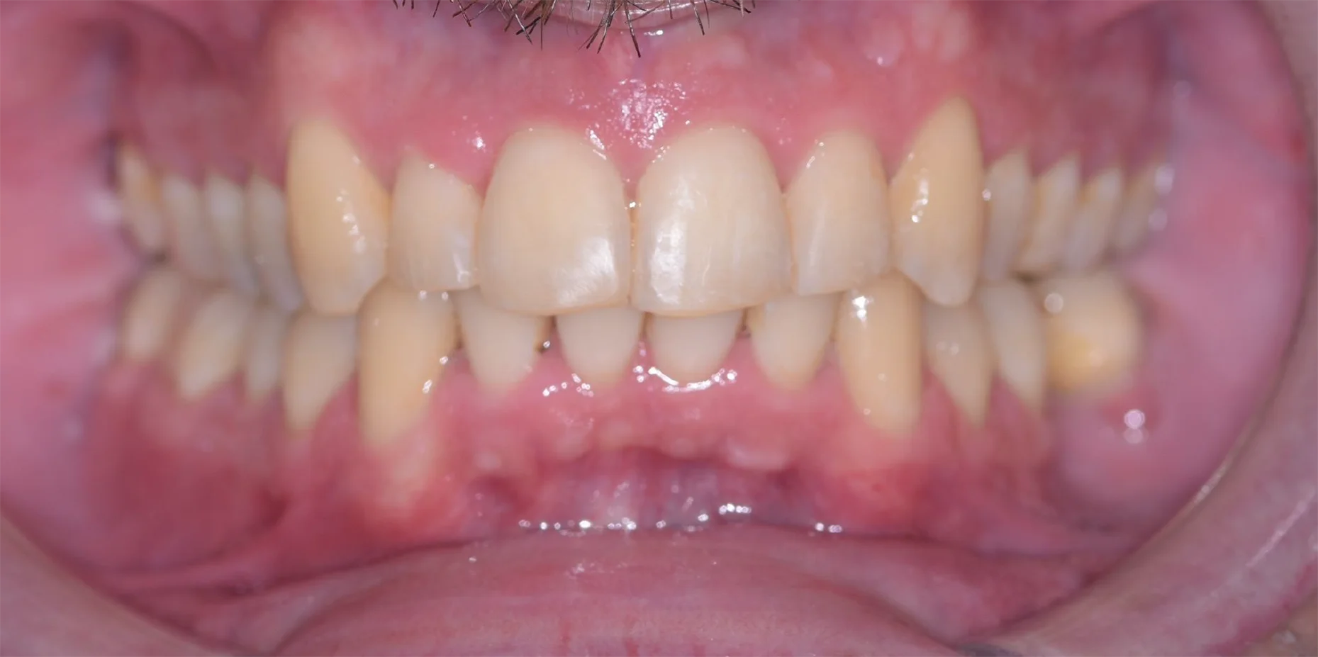 Teeth Straightening After